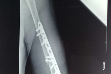 Nhân viên y tế bị tố bẻ gãy tay bệnh nhân