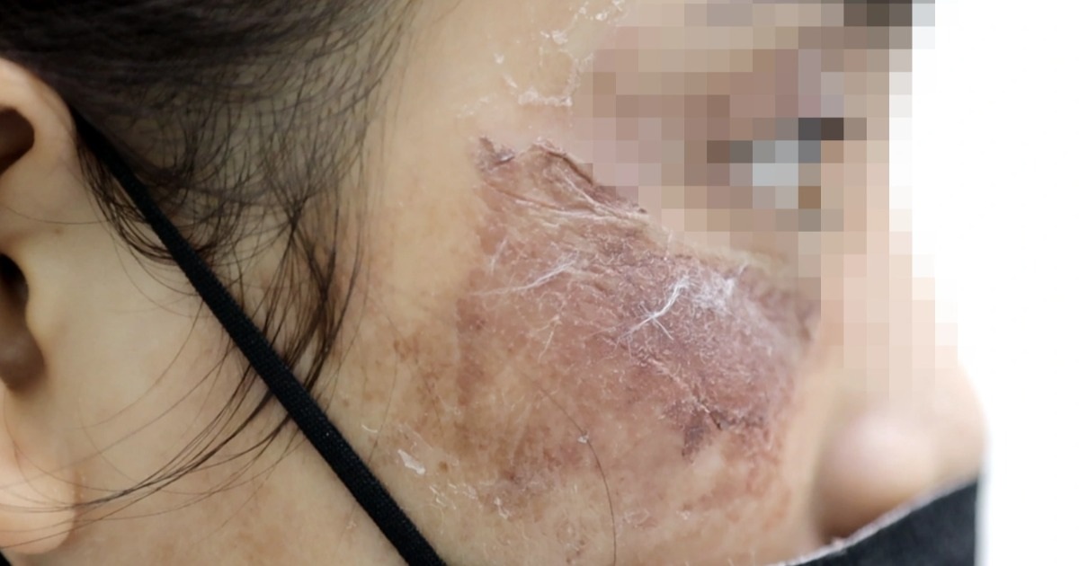 Hiểm họa vì thói quen mua mỹ phẩm, kem bôi da theo "trend" trên mạng