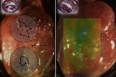 Kỹ thuật mới giúp điều trị tổn thương tim sau cơn đau tim