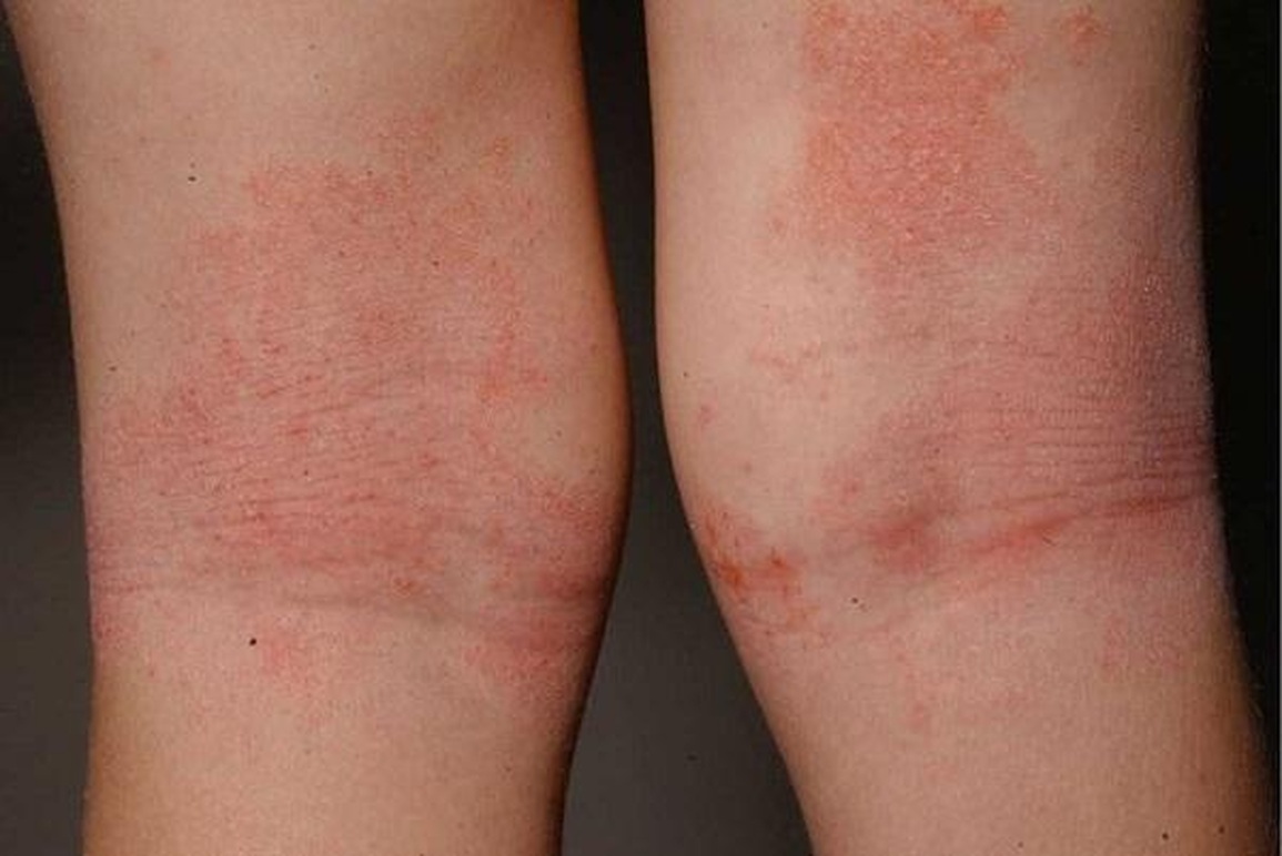 Sự kết hợp Đông - Tây y: Lựa chọn cho bệnh viêm da cơ địa - 2 Sự kết hợp Đông - Tây y: Lựa chọn cho bệnh viêm da cơ địa - 2