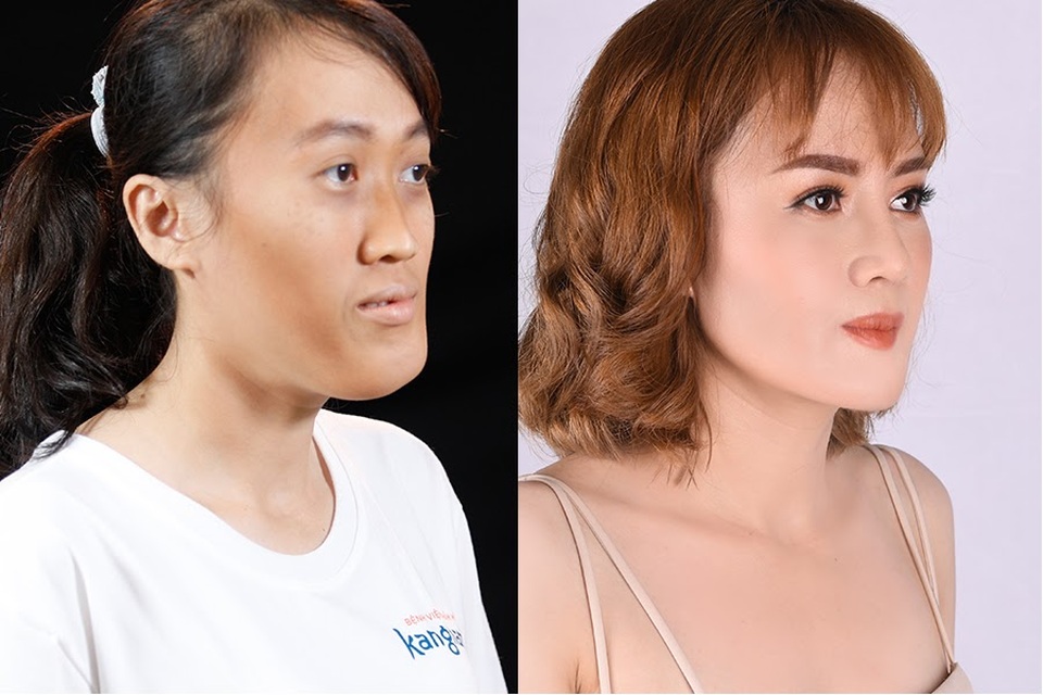 Cần tới 11 tiếng để thực hiện ca phẫu thuật khuôn mặt vặn xoắn hy hữu trong thẩm mỹ - 5