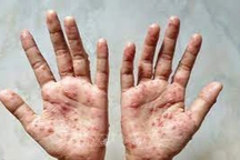 Tiền Giang ghi nhận ca mắc đậu mùa khỉ đầu tiên