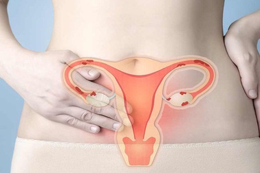 Nhận biết ung thư nội mạc tử cung