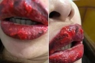Chị em tá hỏa vì môi sưng vều, nhiễm khuẩn hoại tử vì xăm môi “thợ vườn”