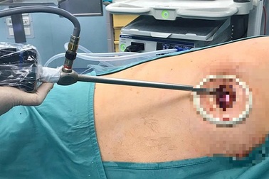 TPHCM: Chàng trai 27 tuổi đang khỏe mạnh bỗng sụp mi mắt, đối diện cái chết