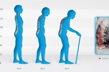 Khám, tư vấn miễn phí bệnh loãng xương