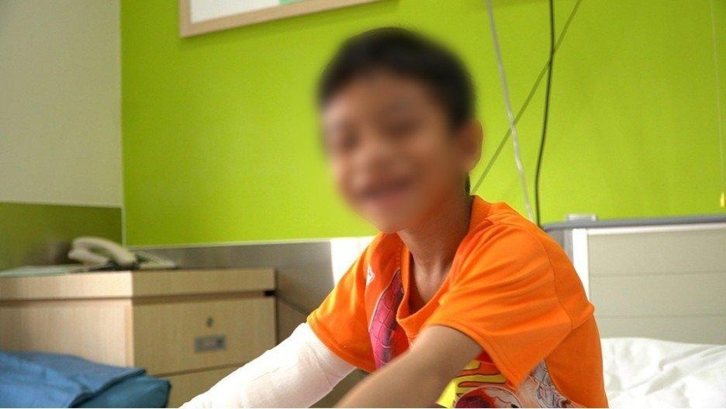 Phẫu thuật phục hồi chức năng cho cánh tay bé trai 6 tuổi bị bỏng - 3 Phẫu thuật phục hồi chức năng cho cánh tay bé trai 6 tuổi bị bỏng - 3