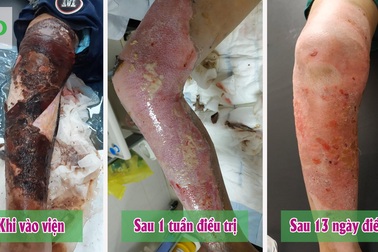 Dùng thuốc đỏ sát trùng vết bỏng, bé trai 7 tuổi hoại tử vùng đùi