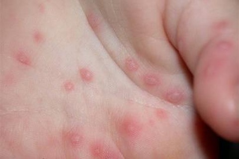 Tay chân miệng đã lan rộng cả nước