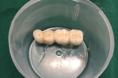 Cầu răng giả 4 chiếc rơi vào phế quản cụ ông 90 tuổi trong lúc làm răng