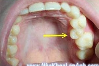 Chỉnh nha cho trẻ em và thiếu niên