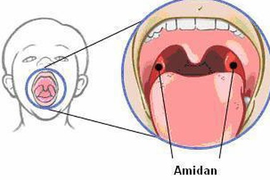 Không nên lạm dụng kháng sinh khi viêm amiđan