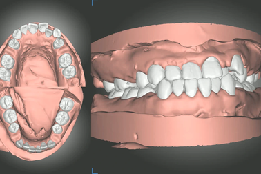 Chen chúc, khớp cắn chéo được điều trị nhờ cá nhân hóa mắc cài
