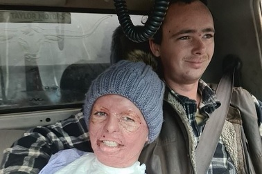 Người phụ nữ chủ động trao cơ hội chia tay cho chồng sau tai nạn bỏng