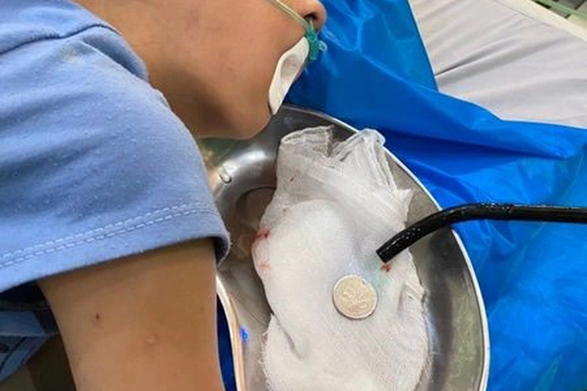 Nội soi thực quản bé trai 8 tuổi lấy ra đồng xu 2 cm - 1 Nội soi thực quản bé trai 8 tuổi lấy ra đồng xu 2 cm - 1