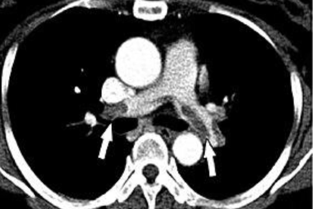 Nữ Việt kiều 60 tuổi tử vong vì biến chứng nặng sau khi hút mỡ, nâng ngực - 2 Nữ Việt kiều 60 tuổi tử vong vì biến chứng nặng sau khi hút mỡ, nâng ngực - 2