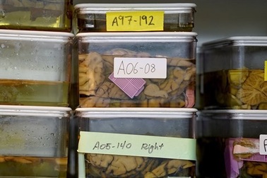 Phát hiện sớm bệnh nhờ định nghĩa mới về Alzheimer