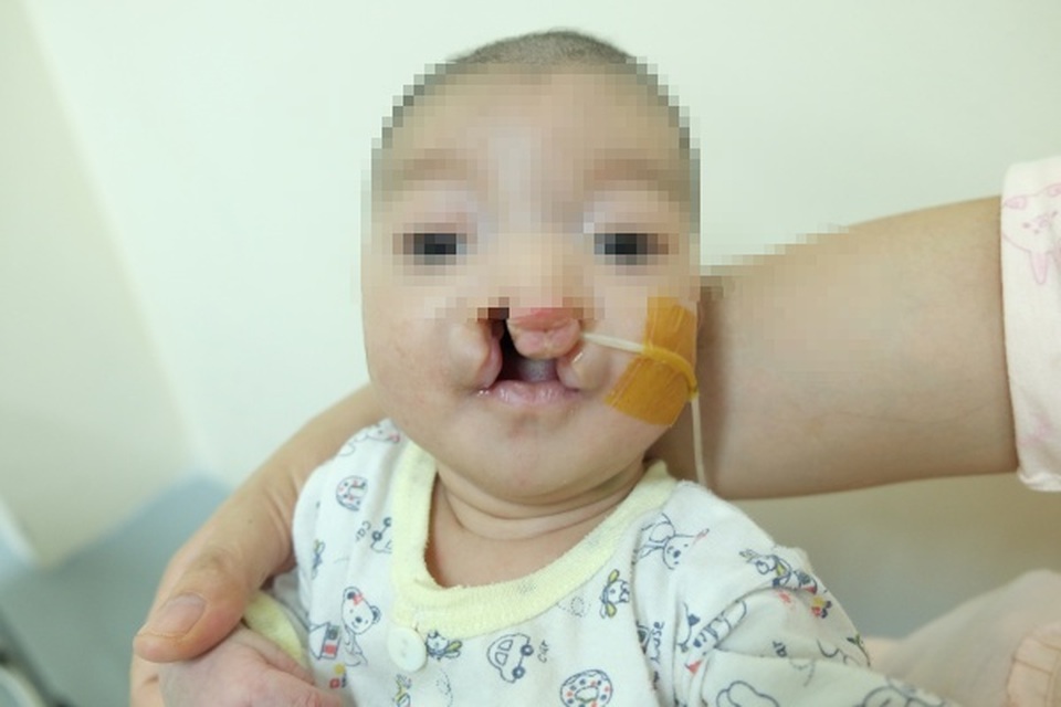 Thực hiện 2 ca mổ cùng lúc cứu bé trai bị suy tim, khe hở môi rộng - 1 Thực hiện 2 ca mổ cùng lúc cứu bé trai bị suy tim, khe hở môi rộng - 1