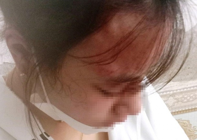Em L. bị chấn động não sau khi bị chủ hàng tạp hoá đánh đập. (Ảnh gia đình cung cấp)
