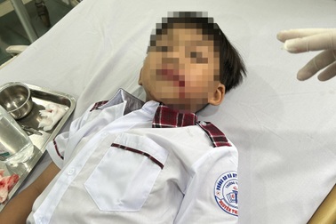 Học sinh bị chó lạ tấn công ngay cổng trường