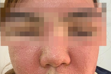 Đắp mặt nạ trắng da, mặt cô gái trẻ sưng vù, nổi mụn