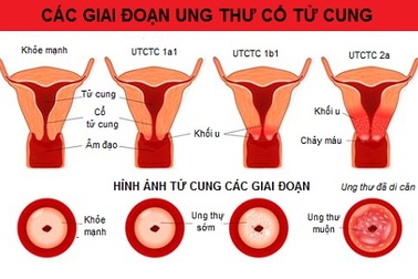 4 giai đoạn của ung thư buồng trứng