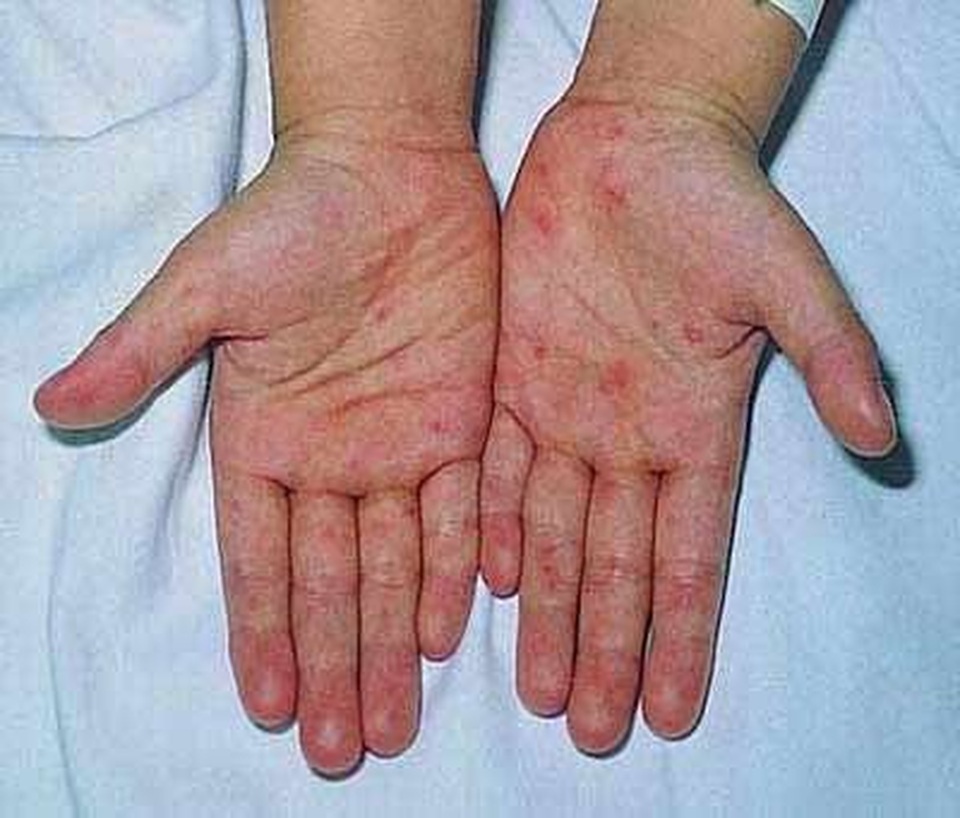 6 biện pháp bảo vệ để không mắc căn bệnh đang tấn công gần 11 nghìn trẻ em - 1 6 biện pháp bảo vệ để không mắc căn bệnh đang tấn công gần 11 nghìn trẻ em - 1