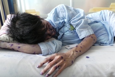 Chùm ca bệnh thủy đậu tại trường tiểu học Nguyễn Du