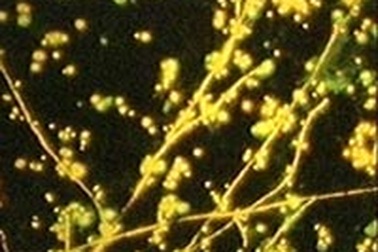 Viêm nhiễm âm đạo do nấm Candida