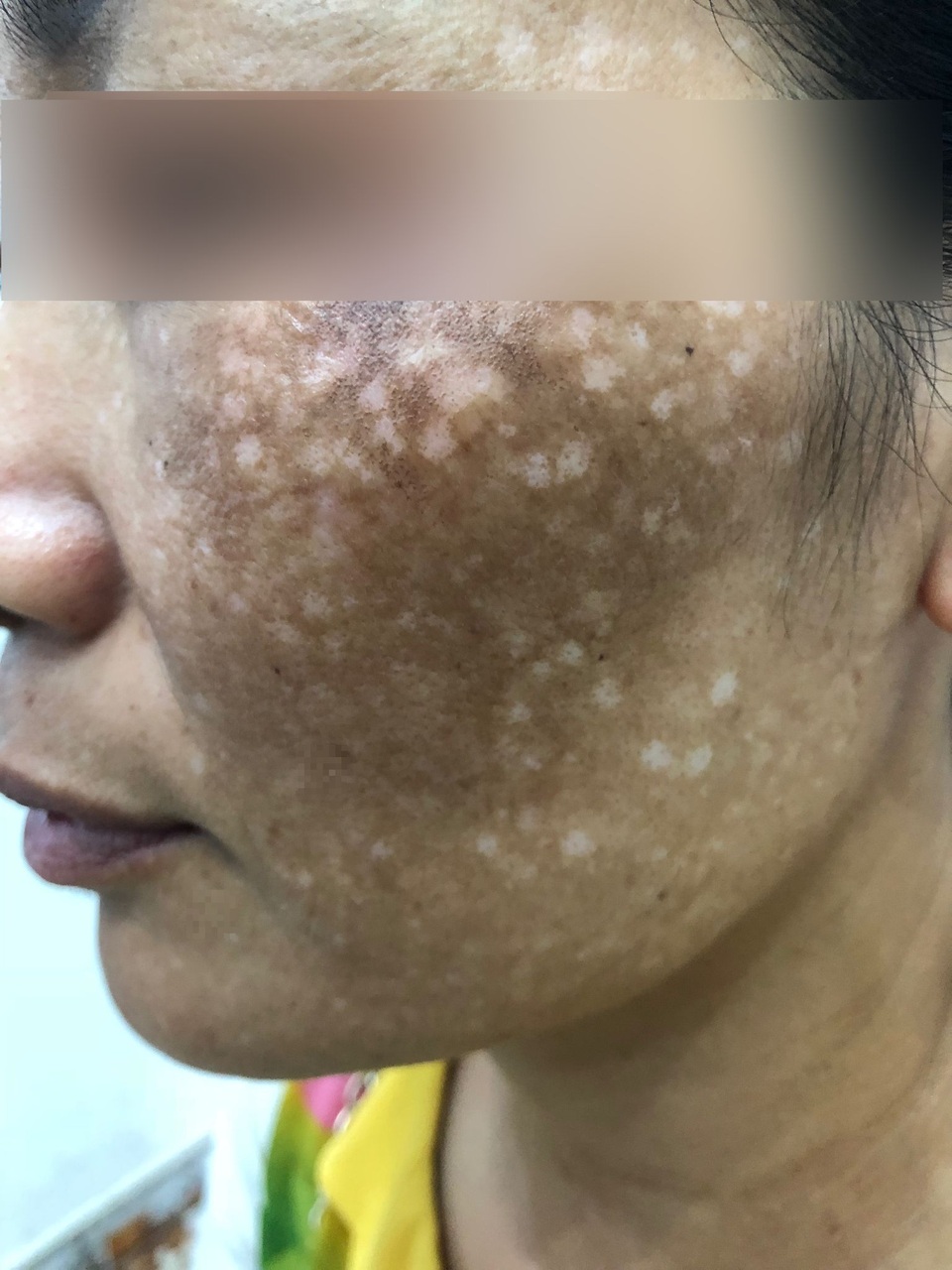 Mặt loang lổ sẹo sau khi chi gần 500 triệu đồng chữa rám má ở spa - 1 Mặt loang lổ sẹo sau khi chi gần 500 triệu đồng chữa rám má ở spa - 1
