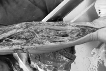 Bé 4 tuổi suýt mất mạng vì người nhà đắp lá thuốc chữa chấn thương