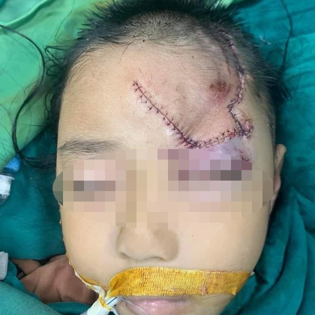 Bé gái 5 tuổi bị chó lạ tấn công, cắn rách mặt - 1 Bé gái 5 tuổi bị chó lạ tấn công, cắn rách mặt - 1