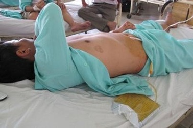 Cuồng ghen, vợ tạt nước sôi vào “của quý” chồng