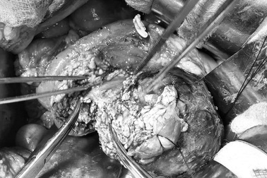 Đau bụng âm ỉ, coi chừng khối u hiểm ở tuyến tụy