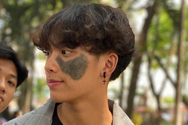 Nam sinh Sài Gòn sở hữu vết bớt lớn: "Mình thấy đó là nét duyên đặc biệt!"