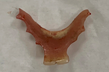 Hàm răng giả chui tọt vào thực quản người đàn ông