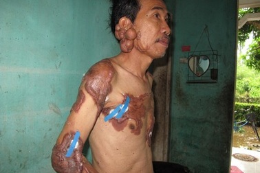 Bệnh lạ: Sẹo mổ thành u thịt khổng lồ đau nhức