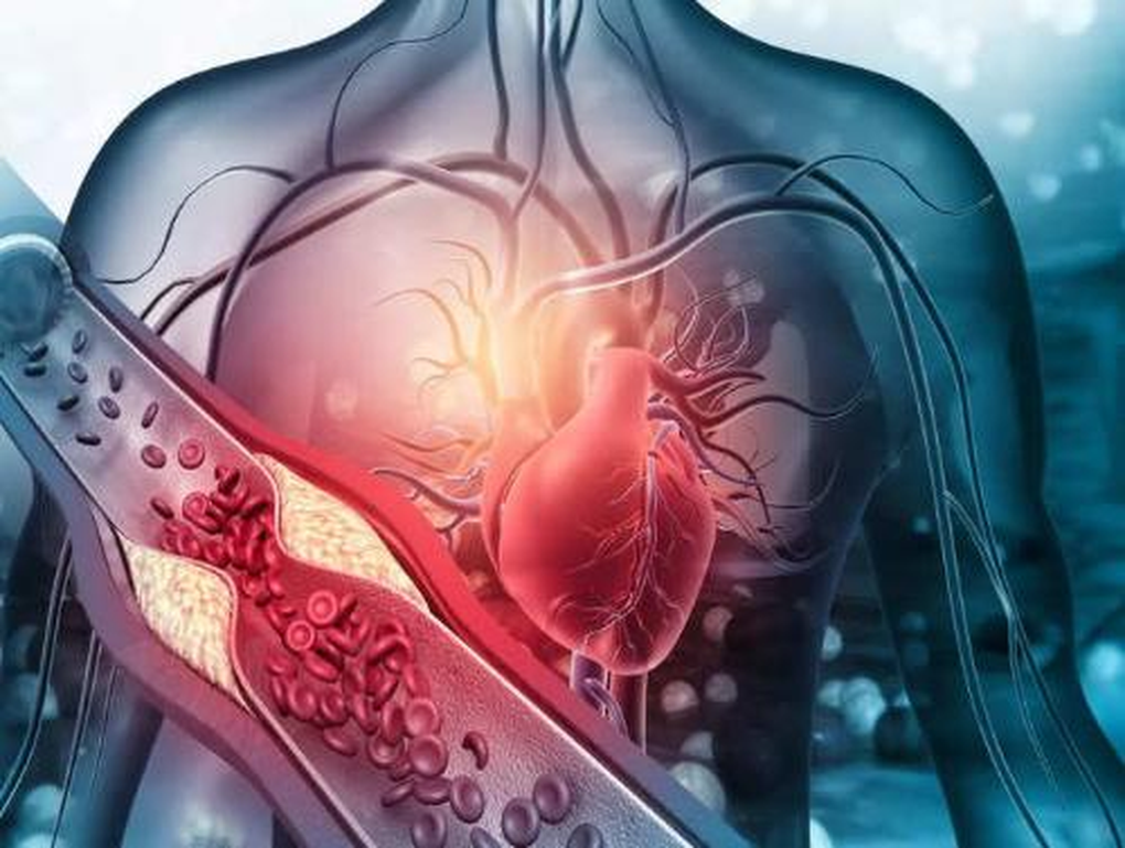 Nguy cơ mắc bệnh tim mạch khi cholesterol tăng - 1 Nguy cơ mắc bệnh tim mạch khi cholesterol tăng - 1