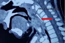 Bé trai 18 tháng tuổi bị cây nĩa xuyên thấu thành họng