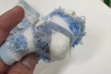 Trẻ sơ sinh suýt hoại tử ngón: Thủ phạm ẩn mình trong bao tay