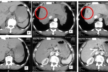 Đau thắt lưng đi khám, bất ngờ phát hiện khối u trong gan