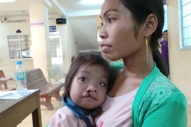 Phẫu thuật miễn phí 70 ca hở hàm ếch