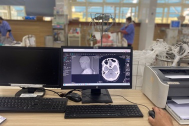 Nam thanh niên bị đột quỵ não chỉ vì uống nhiều rượu