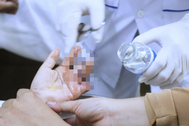 Bé trai cắt mít bị đứt lìa 3 ngón tay, phải mổ 2 lần