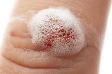 Vì sao khi tẩy trùng vết thương bằng oxy già lại sủi bọt?