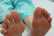 Giải pháp mới giúp điều trị tình trạng đổ mồ hôi chân