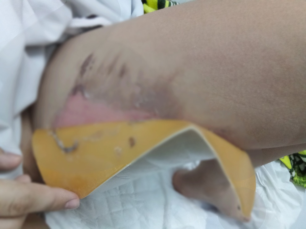 TPHCM: Cha mẹ xông hơi trị Covid-19 cho con, nhiều trẻ bỏng nặng thương tâm - 1 TPHCM: Cha mẹ xông hơi trị Covid-19 cho con, nhiều trẻ bỏng nặng thương tâm - 1