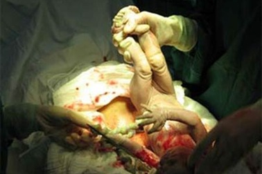 Mổ lấy thai chủ động – Những điều cần biết