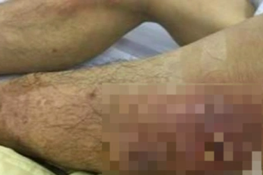 Tài xế chở lợn nhiễm "vi khuẩn ăn thịt" nguy hiểm