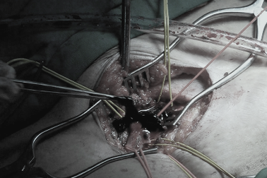 Cứu sống bệnh nhân bị huyết khối tĩnh mạch sâu bằng phương pháp mới